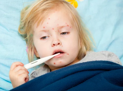 A small child with measles