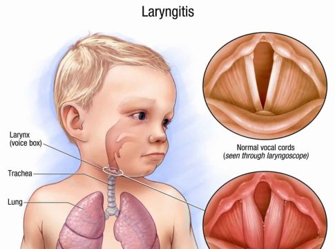Acute laryngitis