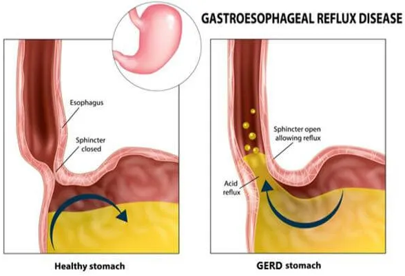 Comparing a healthy stomach to a GERD stomach
