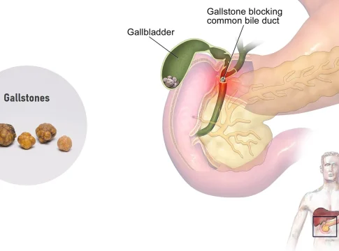 Gall Bladder Stones - Gallstones