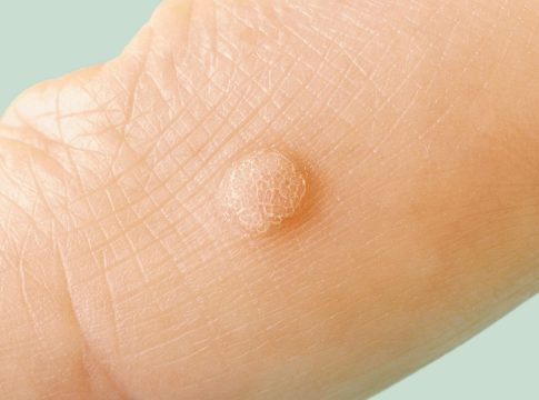 HPV Skin Wart