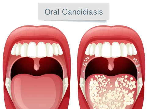 Healthy mouth vs Candidiasis mouth