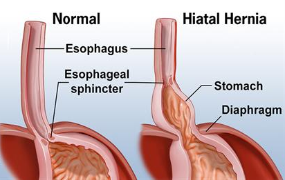 Hiatal hernia can increase the risk of GERD