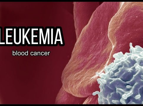 Leukemia blood cancer
