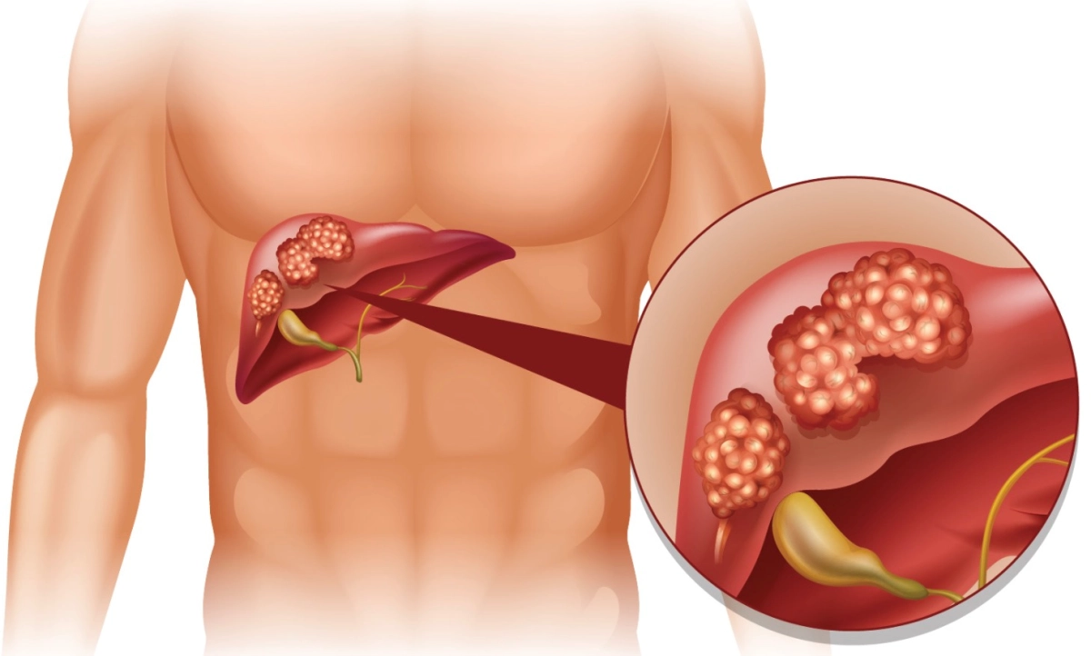 Liver Cancer Liver Cancer