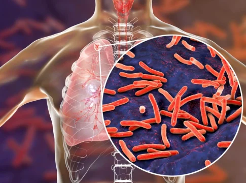Tuberculosis