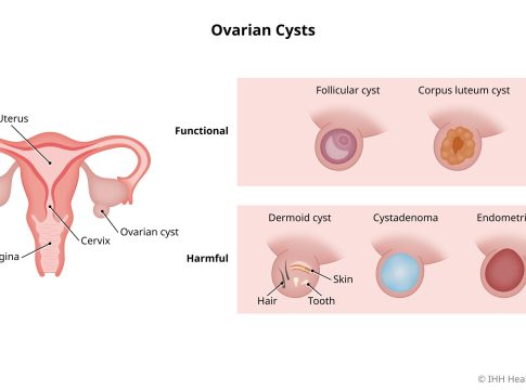 What Causes Ovarian Cysts